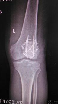 髌骨骨折康复训练视频,视频教程详解与康复步骤