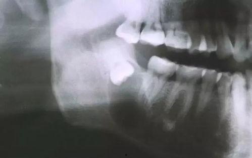 阻生牙拔除术视频,阻生牙拔除术操作步骤及要点解析